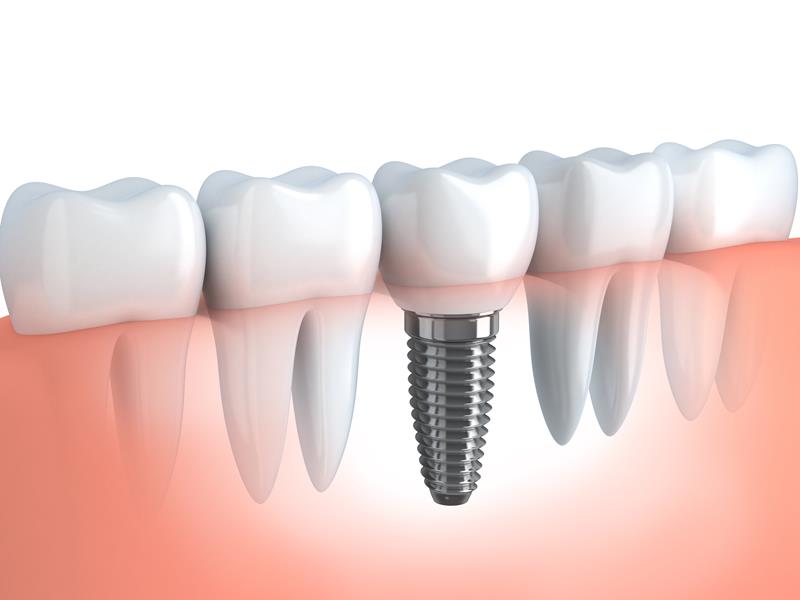 Dental Implants  Spokane, WA 